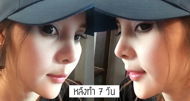 เสริมจมูก แก้จมูก โดยหมออา ที่เมโกะคลินิก คุณโบว์