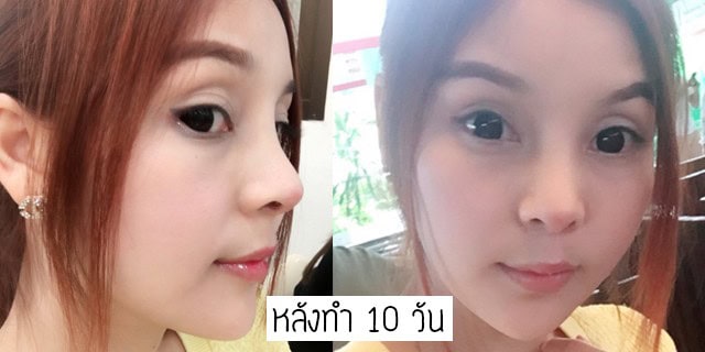 เสริมจมูก แก้จมูก โดยหมออา ที่เมโกะคลินิก คุณโบว์