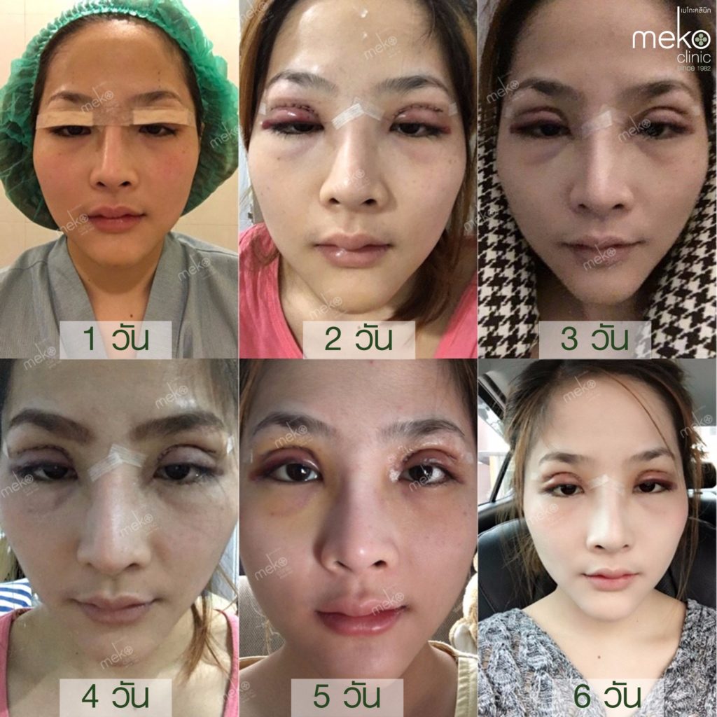 ทำตาสองชั้น สวย คมชัด ถูกใจ โดยแพทย์ศักดิ์ เมโกะ คลินิก ทำตาสองชั้น สวย คมชัด ถูกใจ โดยแพทย์ศักดิ์ เมโกะ คลินิก