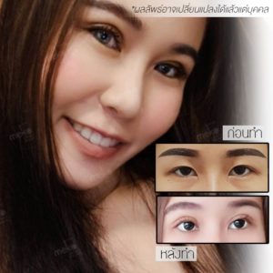 ทำตาสองชั้น ให้สวยคมชัด สยบชั้นตาหลบใน โดยแพทย์ศักดิ์ ทำตาสองชั้น ให้สวยคมชัด สยบชั้นตาหลบใน โดยแพทย์ศักดิ์