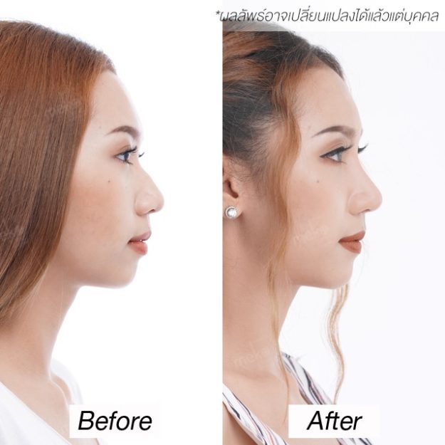 เสริมจมูก ลดฮัมพ์ เพิ่มความหวานของใบหน้า โดยแพทย์ญา เสริมจมูก ลดฮัมพ์ เพิ่มความหวานของใบหน้า โดยแพทย์ญา