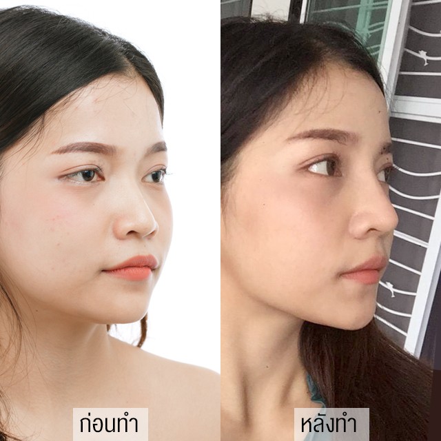 เสริมจมูก โด่งสวย ทรงสาย.ฝอ โดยแพทย์ญา