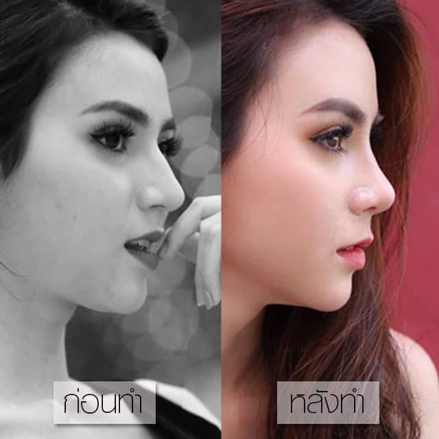 ตะไบฮัมพ์ โดยหมอศุ ที่ เมโกะ คลินิก คุณมีมี่