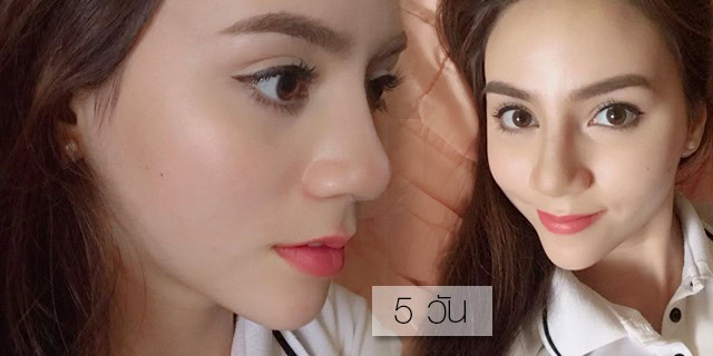 ตะไบฮัมพ์ โดยหมอศุ ที่ เมโกะ คลินิก คุณมีมี่