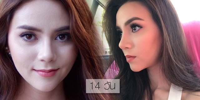 ตะไบฮัมพ์ โดยหมอศุ ที่ เมโกะ คลินิก คุณมีมี่