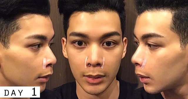เสริมจมูก ตัดปีกจมูก หมอคมเมโกะคลินิก คุณริว