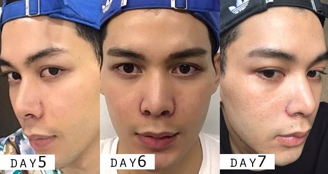 เสริมจมูก ตัดปีกจมูก หมอคมเมโกะคลินิก คุณริว