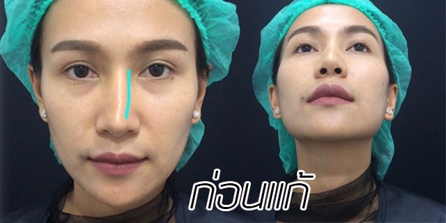 คุณทิพ-แก้จมูก-เสริมจมูก-หมอมนัส-เมโกะ คลินิก