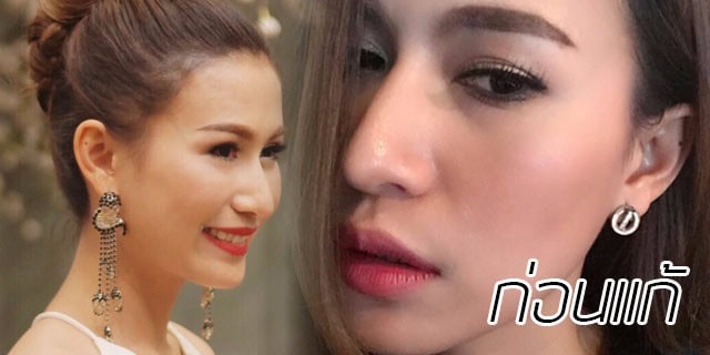 คุณทิพ-แก้จมูก-เสริมจมูก-หมอมนัส-เมโกะ คลินิก