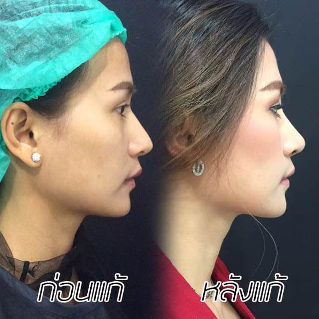 คุณทิพ-แก้จมูก-เสริมจมูก-หมอมนัส-เมโกะ คลินิก