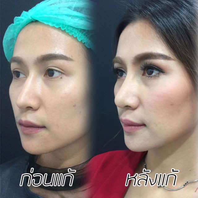 คุณทิพ-แก้จมูก-เสริมจมูก-หมอมนัส-เมโกะ คลินิก