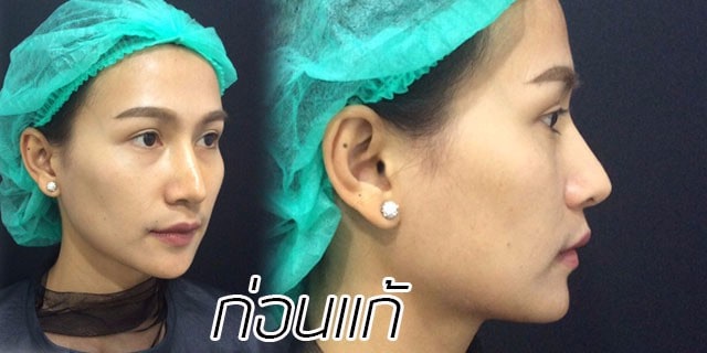 คุณทิพ-แก้จมูก-เสริมจมูก-หมอมนัส-เมโกะ คลินิก