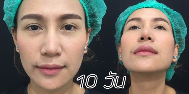 คุณทิพ-แก้จมูก-เสริมจมูก-หมอมนัส-เมโกะ คลินิก