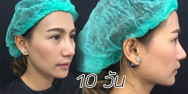 คุณทิพ-แก้จมูก-เสริมจมูก-หมอมนัส-เมโกะ คลินิก