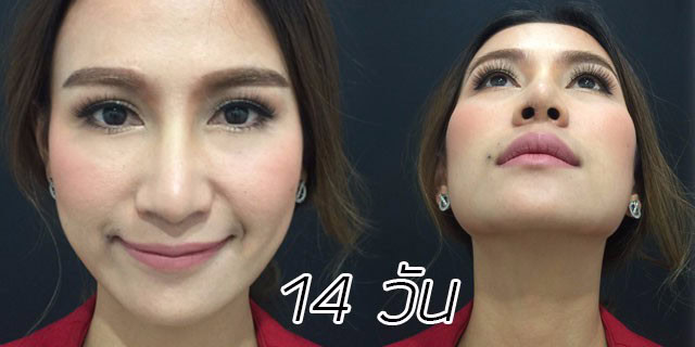 คุณทิพ-แก้จมูก-เสริมจมูก-หมอมนัส-เมโกะ คลินิก