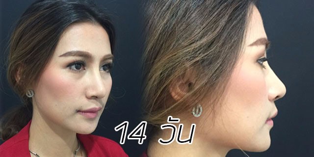 คุณทิพ-แก้จมูก-เสริมจมูก-หมอมนัส-เมโกะ คลินิก