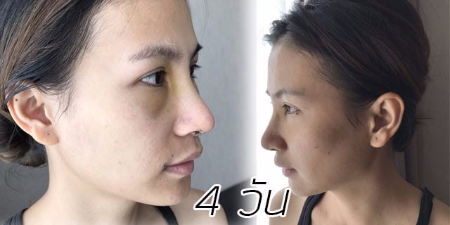 คุณทิพ-แก้จมูก-เสริมจมูก-หมอมนัส-เมโกะ คลินิก