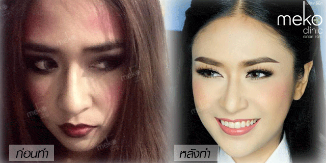 คุณน้อยหน่า-เสริมจมูก-หมอมนัส-เมโกะ-คลินิก