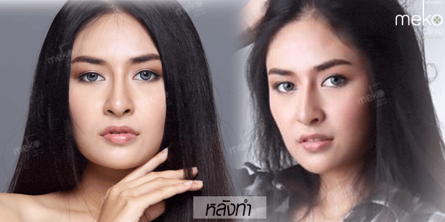 คุณน้อยหน่า-เสริมจมูก-หมอมนัส-เมโกะ-คลินิก