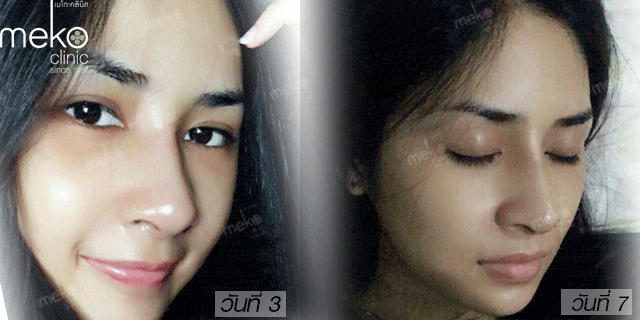 คุณน้อยหน่า-เสริมจมูก-หมอมนัส-เมโกะ-คลินิก