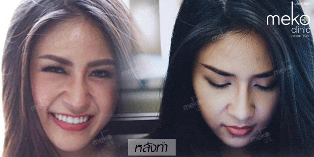 คุณน้อยหน่า-เสริมจมูก-หมอมนัส-เมโกะ-คลินิก