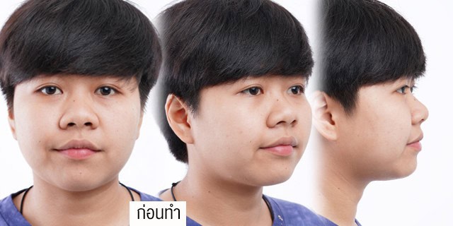 เสริมจมูก โดยหมออา ที่ เมโกะ คลินิก คุณฟิล์ม