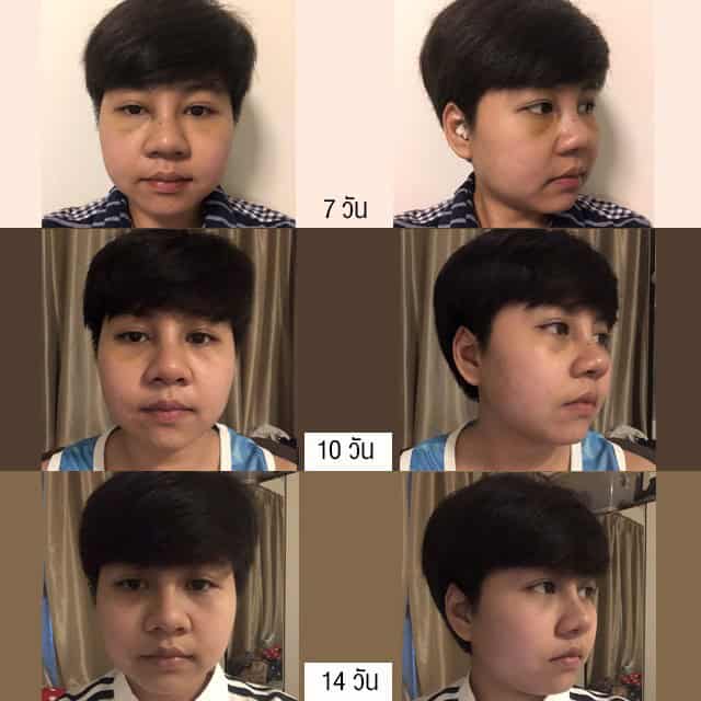 เสริมจมูก โดยหมออา ที่ เมโกะ คลินิก คุณฟิล์ม
