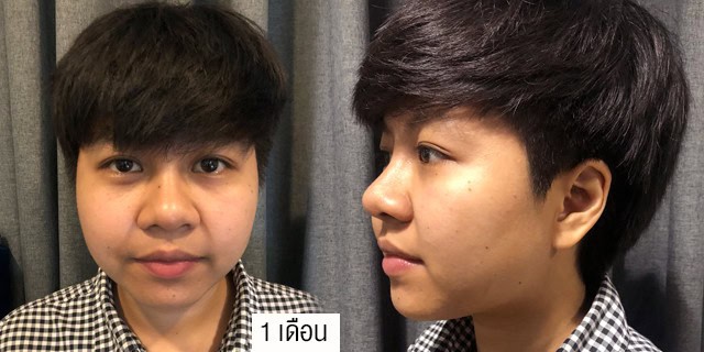 เสริมจมูก โดยหมออา ที่ เมโกะ คลินิก คุณฟิล์ม