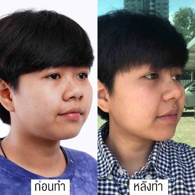 เสริมจมูก โดยหมออา ที่ เมโกะ คลินิก คุณฟิล์ม