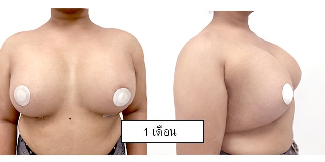เสริมหน้าอก โดยหมอยง ที่ เมโกะ คลินิก คุณซีมง