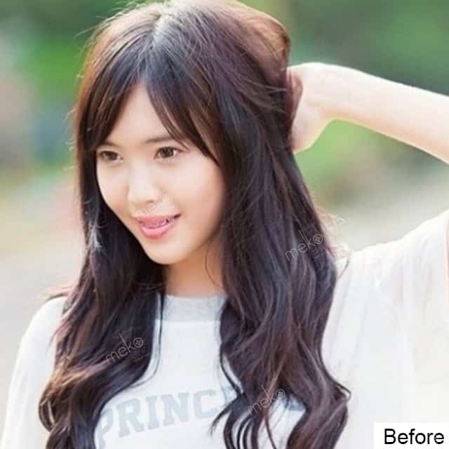 เสริมจมูก หมอมนัส เมโกะคลินิก คูณแบมแบม
