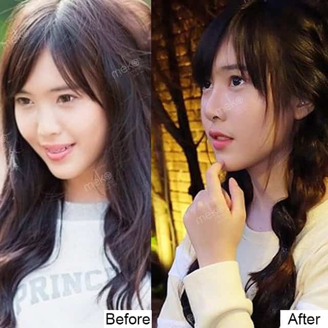 เสริมจมูก หมอมนัส เมโกะคลินิก คูณแบมแบม