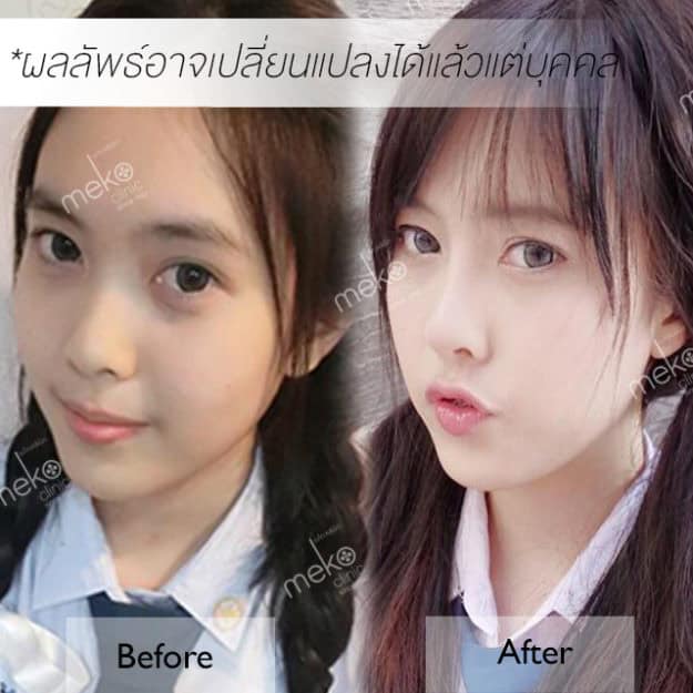 เสริมจมูก หมอมนัส เมโกะคลินิก คูณแบมแบม