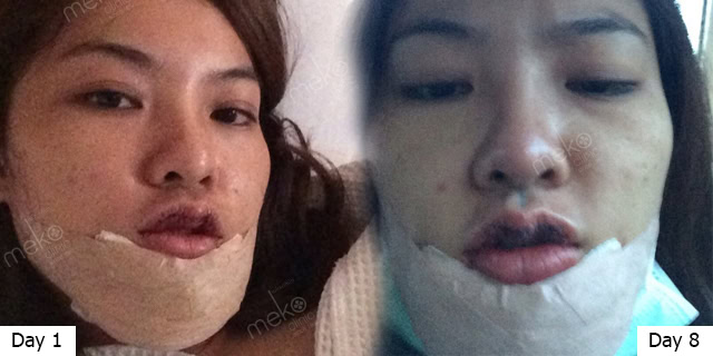 ปากกระจับ+เสริมคาง โดยหมอมนัส ที่ เมโกะ คลินิก คุณนัท