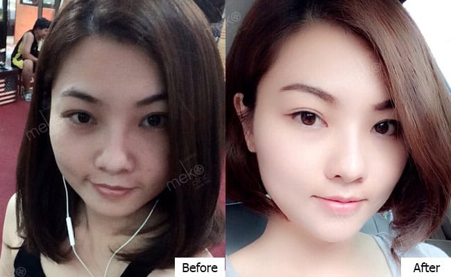 ปากกระจับ+เสริมคาง โดยหมอมนัส ที่ เมโกะ คลินิก คุณนัท