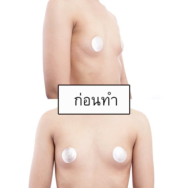 เสริมหน้าอก โดยหมอคม ที่ เมโกะ คลินิก คุณพลอยพัชชา