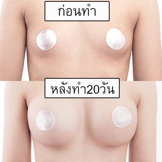เสริมหน้าอก โดยหมอคม ที่ เมโกะ คลินิก คุณพลอยพัชชา