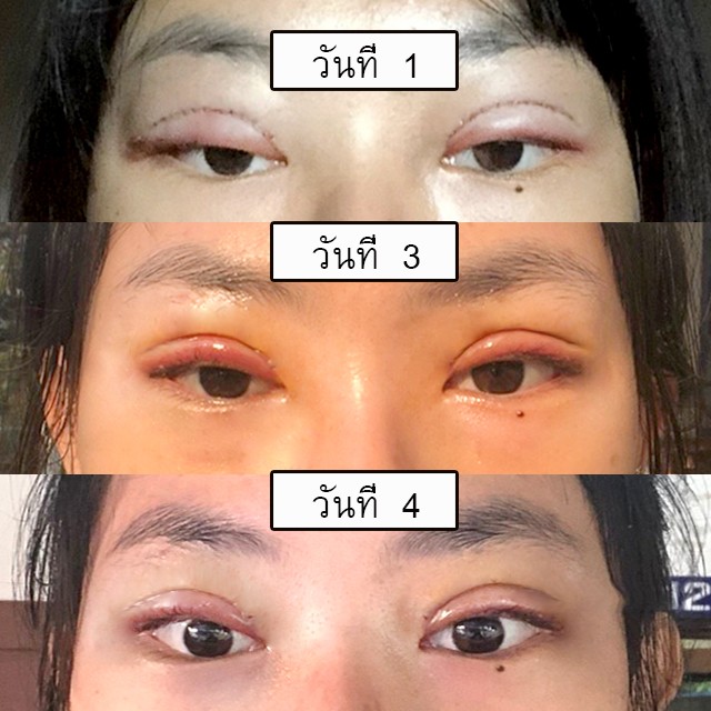 double eyelid surgery swelling