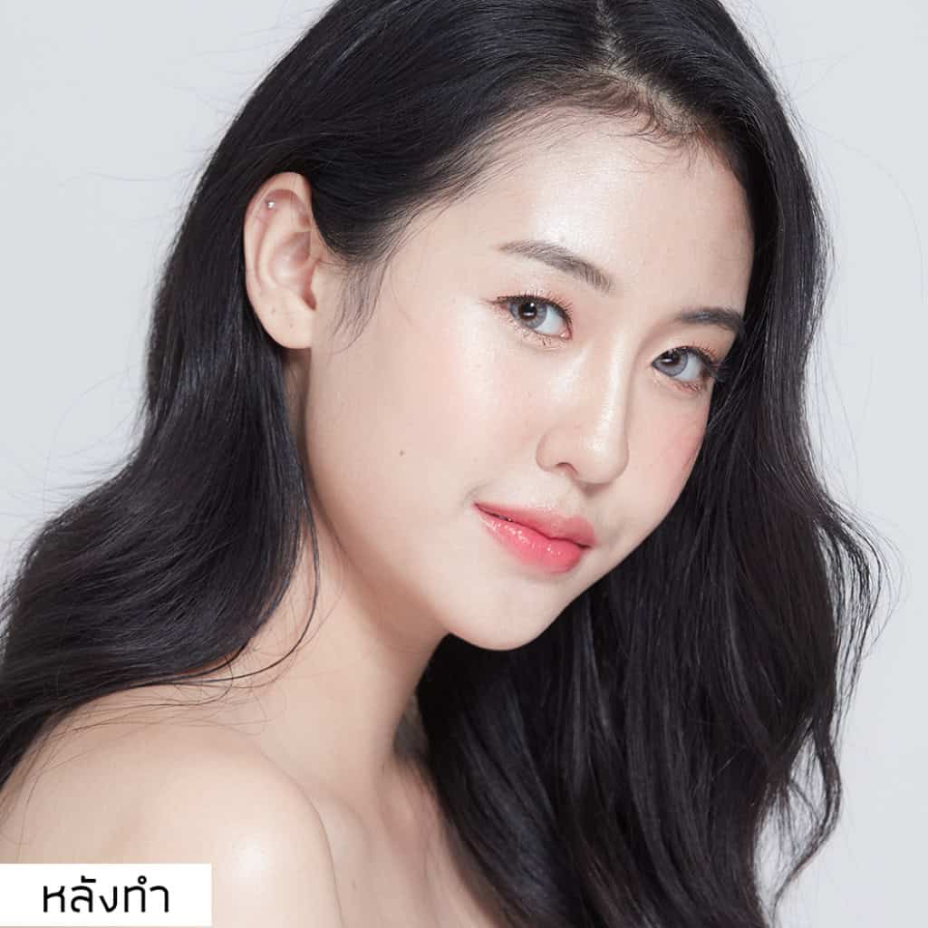 เสริมจมูก หมอมนัส เมโกะคลินิก คุณพลอย
