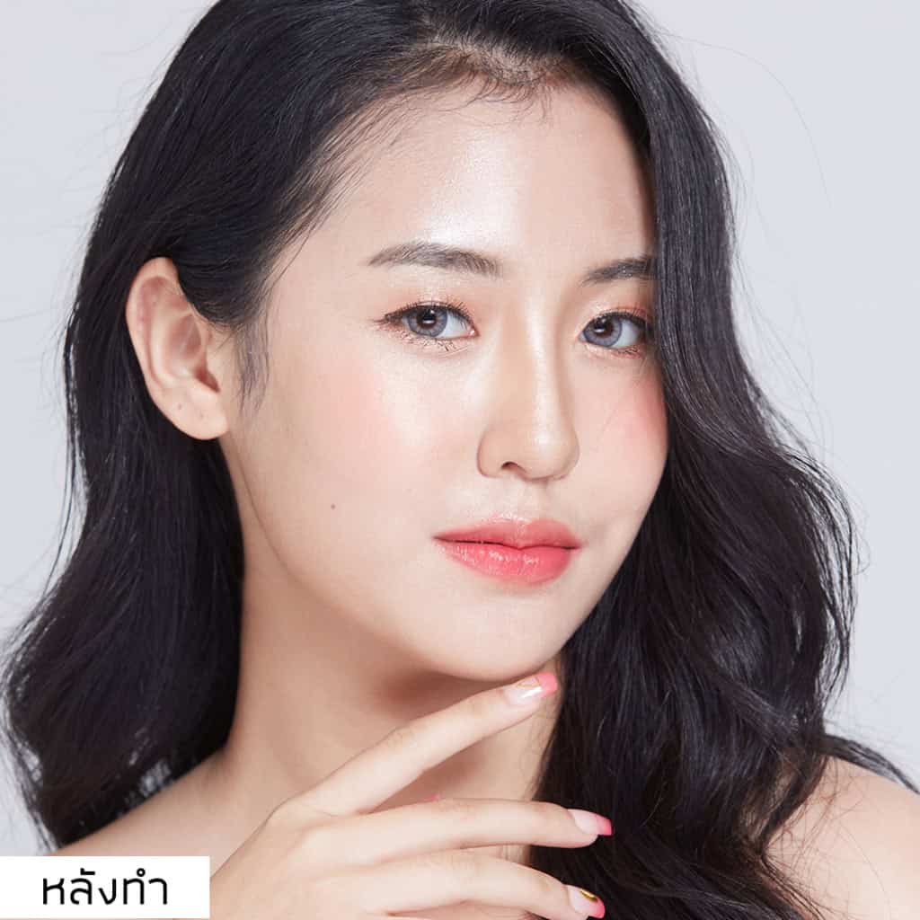 เสริมจมูก หมอมนัส เมโกะคลินิก คุณพลอย