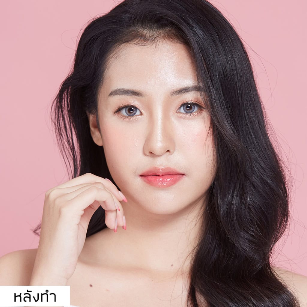 เสริมจมูก หมอมนัส เมโกะคลินิก คุณพลอย