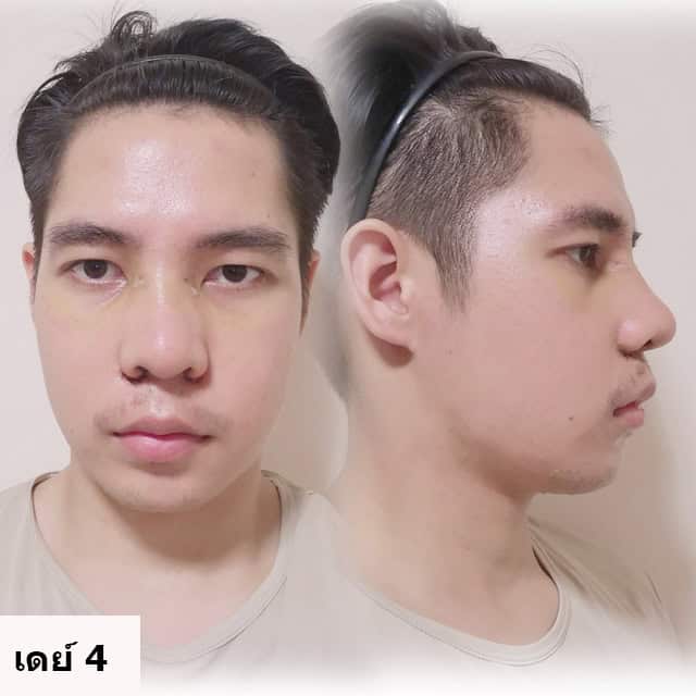 เสริมจมูก โดยหมอยศ ที่ เมโกะ คลินิก คุณเพชร