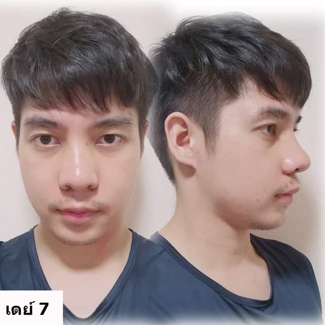 เสริมจมูก โดยหมอยศ ที่ เมโกะ คลินิก คุณเพชร