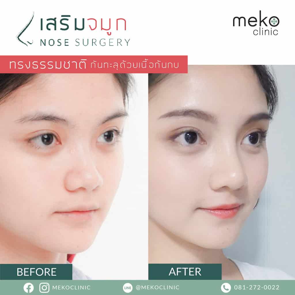 เสริมจมูก เมโกะ คลินิก