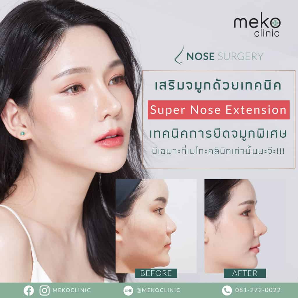 เสริมจมูก เมโกะ คลินิก