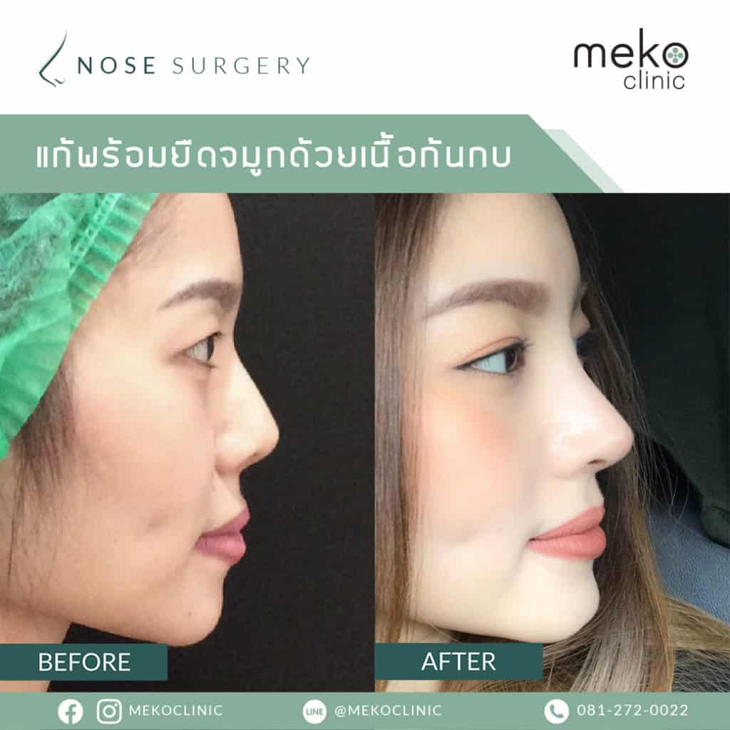 เสริมจมูก เมโกะ คลินิก