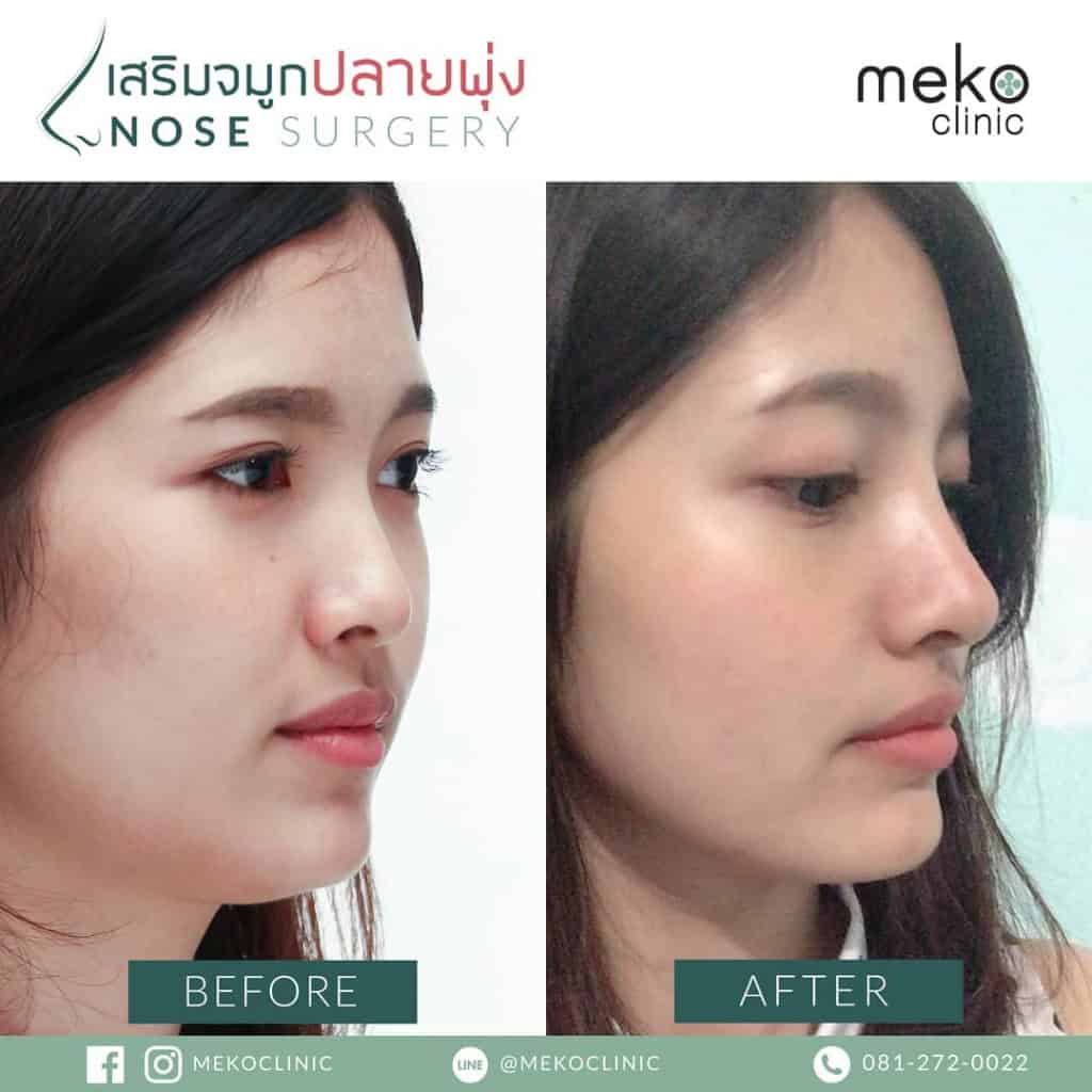เสริมจมูก เมโกะ คลินิก