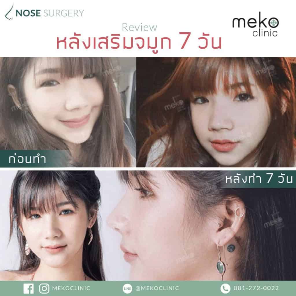 เสริมจมูก เมโกะ คลินิก