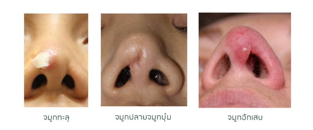 เสริมจมูก เมโกะ คลินิก