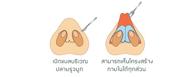 เสริมจมูก เมโกะ คลินิก